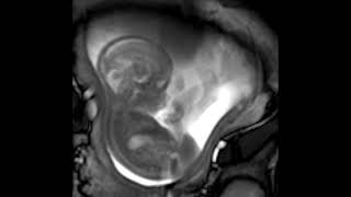 MRI scan at 21 weeks [upl. by Johnsten]