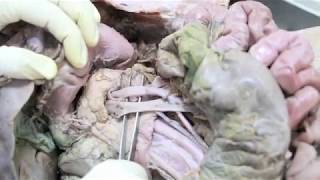 Anatomy Dissection of Pancreas amp Duodenum [upl. by Docilu39]