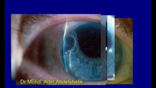 Slit lamp examination  whole presentation [upl. by Columba]