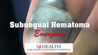 Subungual Hematoma Emergency and Trephination Procedure [upl. by Waddle]