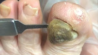 Onychomycosis trimming treatment instant removal【Foot Scalpel】 [upl. by Aric]