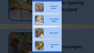 Liposarcoma Screening amp Treatment Options [upl. by Eecrad245]