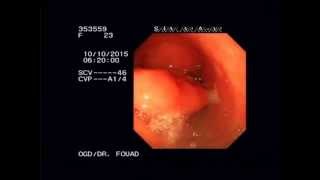 gastric plication stenosis endoscopy Dr Fouad Alahdab [upl. by Nimzay]