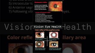 Rubeosis Iridis  Color reflex of the Pupillary area [upl. by Meridith28]