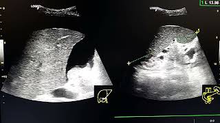 buddchiari syndrome ultrasound [upl. by Merrill68]