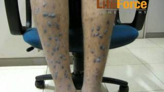 Severe Hypertrophic Lichen Planus with Severe Lichenification on Legs Treated at Life Force [upl. by Attenaz]