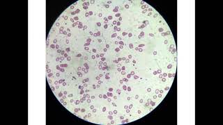 microcytic hypochromic anaemia [upl. by Leirua]