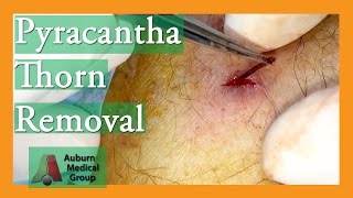 Foreign Body Removal of Pyracantha Thorn  Auburn Medical Group [upl. by Anehsat]