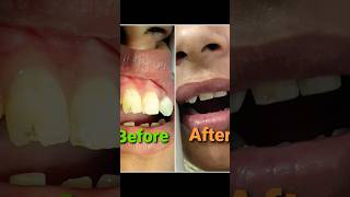 big teeth reshaping OralDentalCare [upl. by Ahseekat]