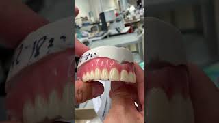 Upper Denture that clasps to one Tooth [upl. by Freda]