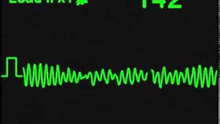 Fibrilacion Ventricular  Ventricular Fibrillation [upl. by Heidt392]