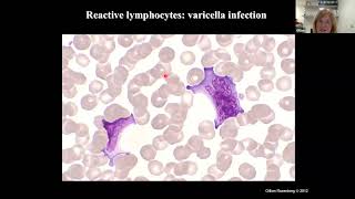 Lymphocytes Reactive vs Neoplastic [upl. by Namzaj383]