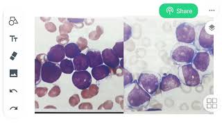 Myeloblast vs Lymphoblast Learn the difference bw them [upl. by Repohtsirhc]