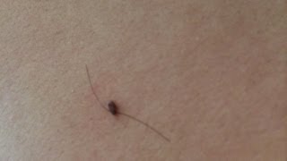 How To Get Rid of Skin Tags Naturally [upl. by Anu772]