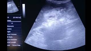 Gallbladder adenomyomatosis on Ultrasound diffuse type [upl. by Ased720]