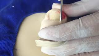 Aula 06  Cantoplastia unha encravada  ingrown nail [upl. by Atilegna]