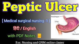 Peptic ulcers bsc nursing 2nd year  Peptic ulcer in hindi  Peptic ulcer medical surgical nursing [upl. by Yreved]