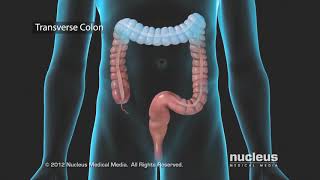 Colon Problems Diverticular Disease [upl. by Gearard]