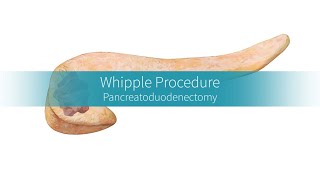 Whipple Procedure Why and How the Surgery Is Performed [upl. by Anileve]