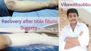 Tibia fibula surgery recovery vibewithsubbu recovery after leg surgery time taken for recovery [upl. by Olag]