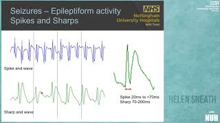 Neurophysiological Monitoring on ICU brain waves trends and artefacts [upl. by Toile562]