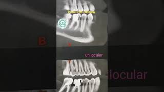 Dental cyst radiology حويصلات الفكين [upl. by Neelav]