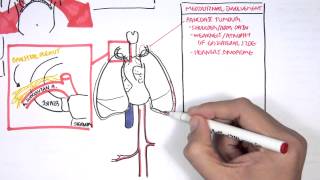 Lung Carcinoma Lung cancer [upl. by Ad177]