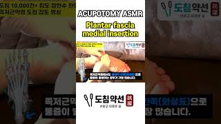 ACUPOTOMY ASMR Plantar fascia  Calcaneus insertion [upl. by Atinaej94]