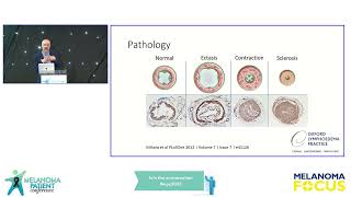 Mr Alex RamsdenLymphoedema surgery for melanoma patients [upl. by Zetrom]