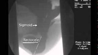 Laparoscopic Resection Rectopex [upl. by Asilej]