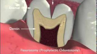 Dental Sealants and Fissurotomy [upl. by Asante]