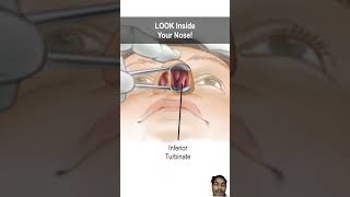 Nasal obstruction due to turbinate hypertrophy doctor nasalcongestion anatomy animation [upl. by French]