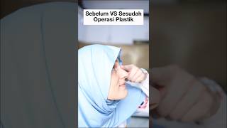 Sebelum Operasi Plastik Vs Sesudah [upl. by Jaala464]