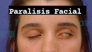 Paralisis Facial ¿Que tienes que hacer  Tratamiento inmediato [upl. by Nagy]