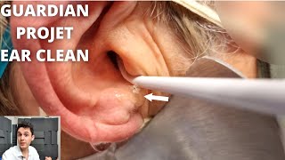 GUARDIAN PROJET Ear Irrigation Ear Wax Removal [upl. by Knutson552]