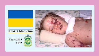 Krok 2 Medicine  Year 2019  049 Ministry of Public Health of Ukraine [upl. by Eednim]