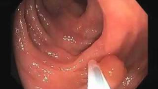 Colonoscopy Video Tour Removal of a Colon Polyp Polypectomy [upl. by Domela892]