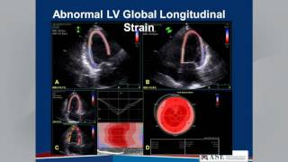 Echocardiographic Assessment of LV Diastolic Function Webinar [upl. by Cariotta]