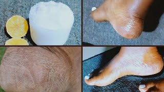 GET Rid of Dead Skin on your Feet FAST with Kitchen Ingredients [upl. by Latonia]