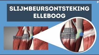 Slijmbeursontsteking elleboog Ontdek de oplossing [upl. by Figge99]