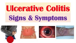 Ulcerative Colitis Signs and Symptoms amp Why They Occur and Complications [upl. by Yrmac61]