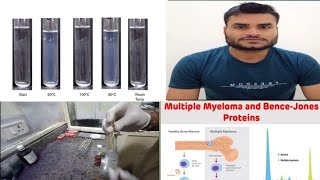 BenceJones protein test in hindi Multiplemayloma urine multiplmyloma [upl. by Ennasor]