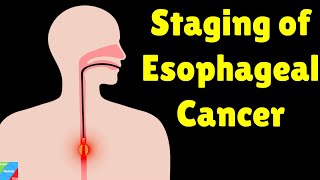 Esophageal Cancer Staging  TNM Staging for Esophageal Cancer  AJCC Staging System [upl. by Boorer]