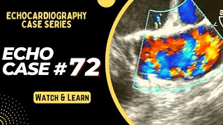 ECHO CASE 72  Echocardiography for Beginners  Echo spot diagnosis Series  Cardiology [upl. by Liberati]