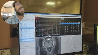 CSF Flow study Philips 3T post processing VideoPart2avnishradiology [upl. by Abba]