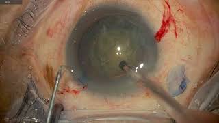 Clip  33 4K Toric IOL and soft cataract management [upl. by Ekusoyr]