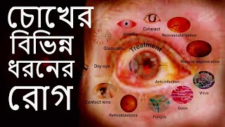 চোখের বিভিন্ন ধরনের রোগ এবং তাদের লক্ষণ16 type of Eye Diseases [upl. by Annayt]