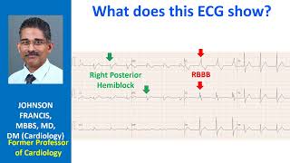 What does this ECG show [upl. by Arratahs53]