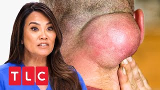 Ein Tumor im Nacken  Dr Pimple Popper  TLC Deutschland [upl. by Nosneh]