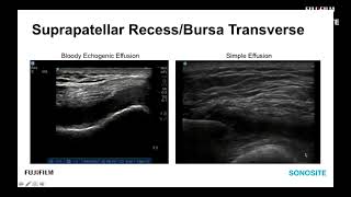 Webinar Ultrasound Evaluation of the Anterior Knee [upl. by Janey]